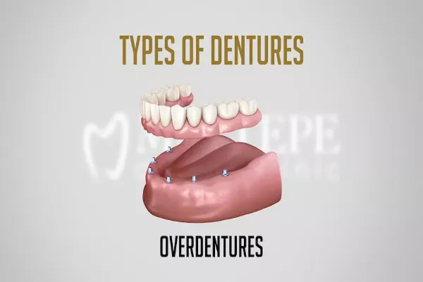 Enhancing Denture Stability with Overdenture Abutments: A Guide